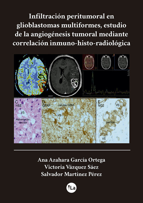 INFILTRACION PERITUMORAL EN GLIOBLASTOMAS MULTIFORMES, ESTUD
