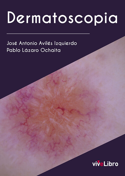 DERMATOSCOPIA PRACTICA VOL 1 SEMIOLOGIA DERMATOSCOPICA